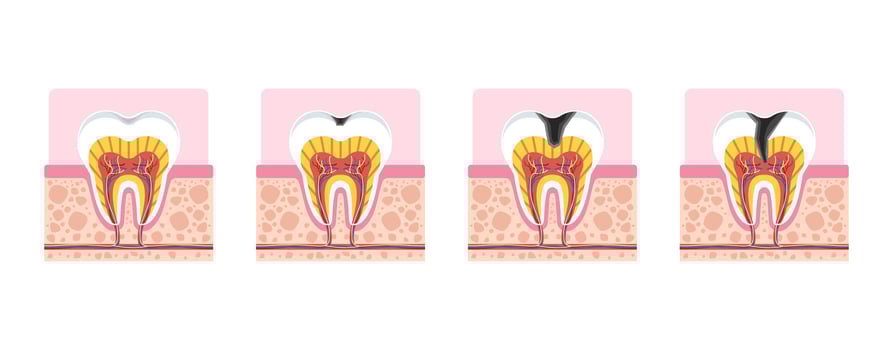 Tooth decay progression stages cross section for dental education, showing enamel damage, dentin exposure, and pulp infection. vector