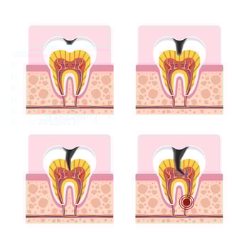 Tooth decay 4 stages cross section showing cavity development from enamel to pulp infection for dental education. vector