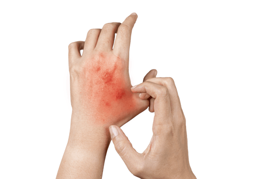 Psoriasis skin, rash and scaling on the patient skin. The concept of chronic disease treatment. png