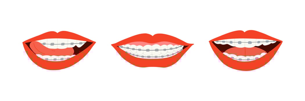 A collection of red lips smiling with visible dental braces. Includes three unique smiles showcasing orthodontic braces. Perfect for dental clinic promotions vector