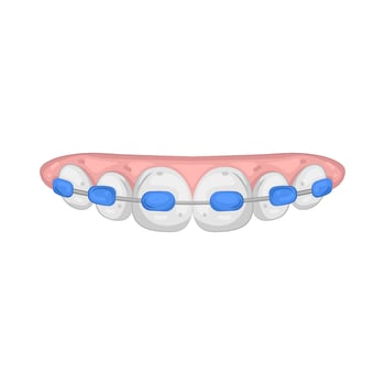 Illustration of Dental Braces vector