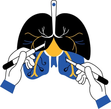 A doodle style illustration showing lungs surgery vector