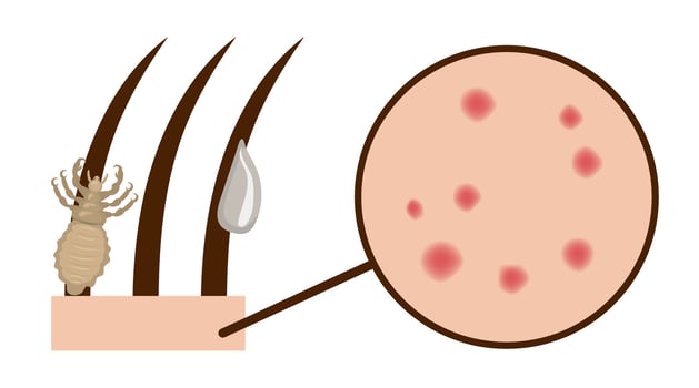 Head louse clinging to hair and causing itchy rash vector