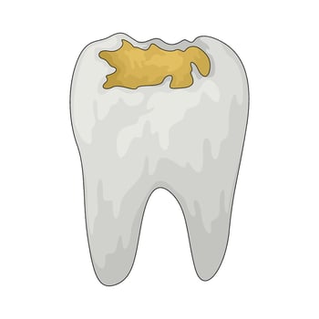 tooth cavity illustration vector