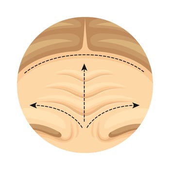 Cosmetic surgery on female forehead with dotted lines. Plastic surgery illustration vector