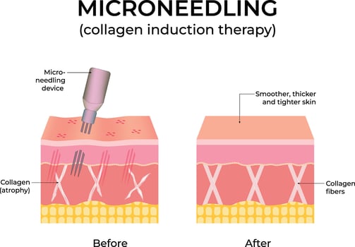 Microneedling Collagen Induction Therapy Diagram Design Illustration vector
