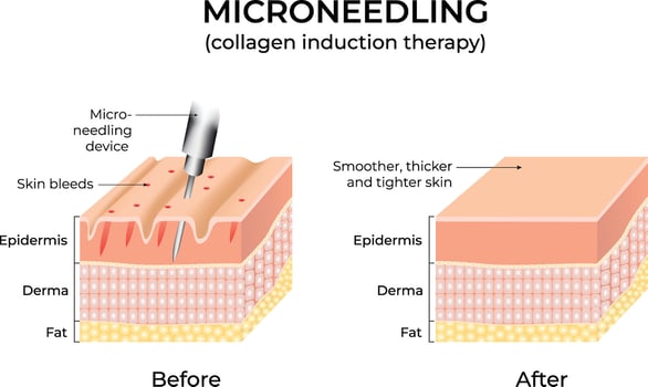 Microneedling procedure illustration showing skin layers before and after treatment Design vector