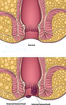 illustration of hemorrhoid vs healthy anus diagram vector