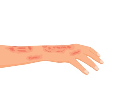 Male hand with serious burn injury vector