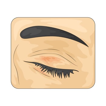 bruise on the eye vector
