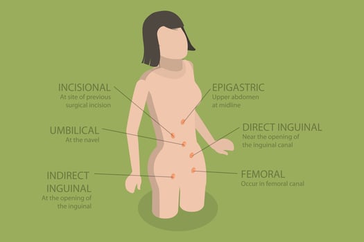 3D Isometric Flat Illustration of Type Of Abdominal Hernias, Inguinal Hernia vector