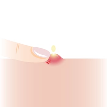 Infographic of squeeze inflammatory acne with one finger on skin illustration isolated on white background. Pustule on skin, squeezing, popping pimple. Skin care and beauty concept. vector