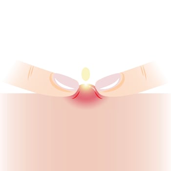 Infographic of squeezing pimple with two fingers on skin illustration isolated on white background. Pustule, inflammatory acne on skin, squeeze, popping pimple. Skin care and beauty concept. vector
