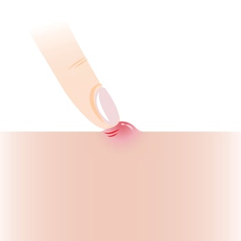 Infographic of pick at pimple with finger on skin illustration isolated on white background. Papule, inflammatory acne on skin, squeeze, pop pimple. Skin care and beauty concept. vector