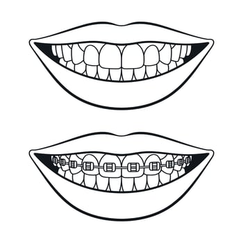 Mouth with teeth and mouth with teeth with braces illustration in black and white outline style for dental clinic vector