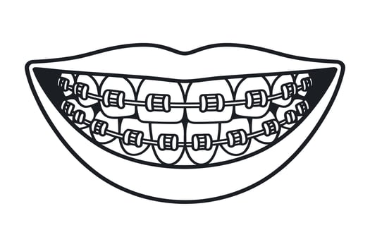 Illustration of a Smiling Mouth with Teeth Fitted with Braces Orthodontic Treatment for Dental Alignment and Improved Oral Health and Aesthetics vector