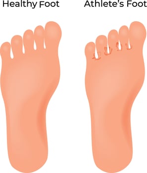 Athletes Foot vs Healthy Foot Illustration vector