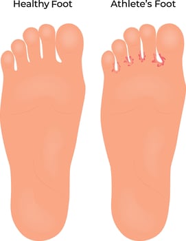 Athletes Foot vs Healthy Foot Science Design Illustration vector