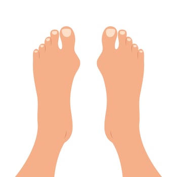 Human feet with deformities of big toe joint. Top view of bare feet with Hallux valgus deformation vector