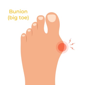 Human foot with deformities of big toe joint. Bare foot with Hallux valgus deformation vector