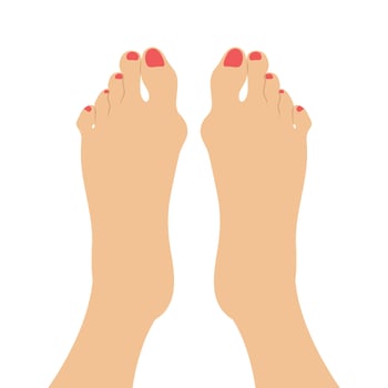 Women feet with a Hallux valgus deformation. Bunion of a big toe vector