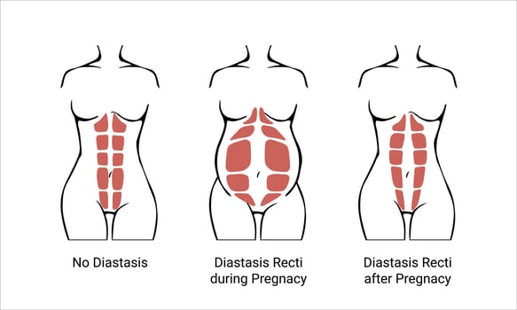 Different types of Diastasis. Diastasis in a woman before, during and after pregnancy. The anatomy of a Woman. A woman's muscular corset before and after childbirth. illustration vector