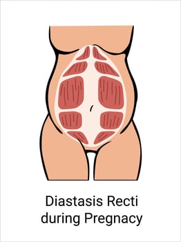 Diastasis Recti during Pregnacy. The anatomy of a Woman. A woman's muscular corset during childbirth. illustration vector