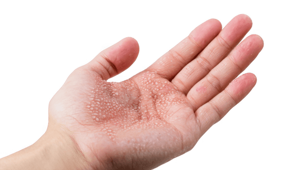 Hand showing dyshidrosis eczema blisters on palm skin condition png