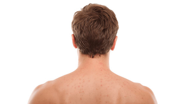 Man showing acne on his back on transparent background png