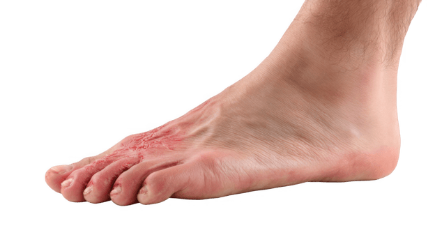 Diabetic foot ulcer showing severe skin damage on transparent background png