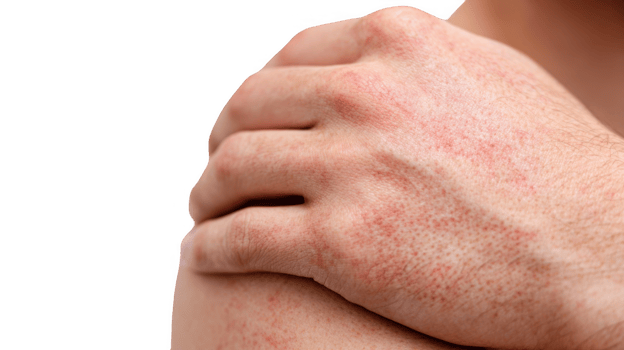 Man suffering from dermatitis is scratching his shoulder with red rash on transparent background png