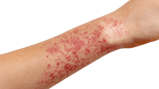 Measles rash closeup showing red spots on arm with transparent background png