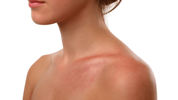 Woman showing mild sun rash on shoulder on transparent background png