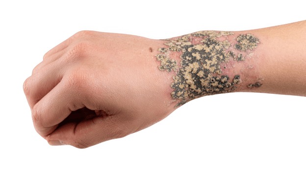 Lichen planus showing skin manifestations on wrist with transparent background png