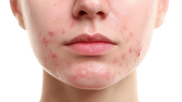 Woman showing acne breakout on transparent background png