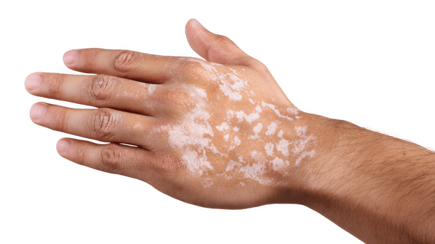 Hand showing vitiligo symptoms on transparent background png