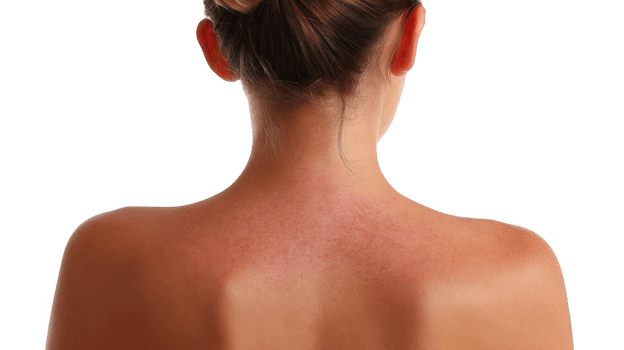 Woman showing sunburned skin on back and shoulders on transparent background png