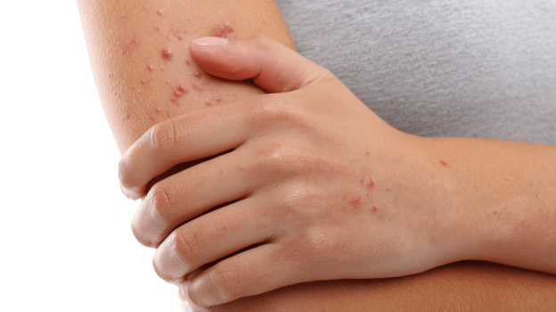 Woman holding itching arm with allergy symptoms on transparent background png