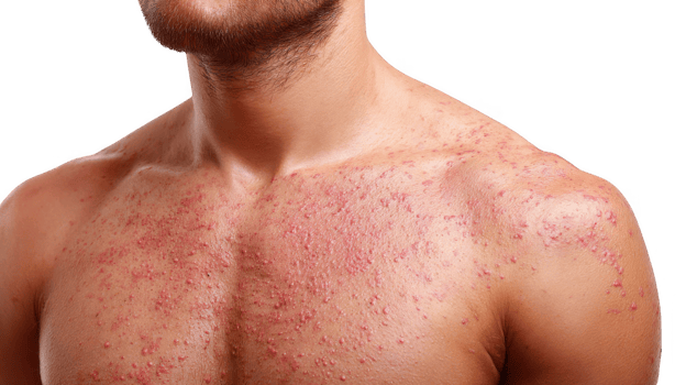 Man showing measles rash on chest and shoulder on transparent background png