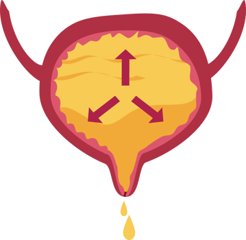 Overflow incontinence illustration png