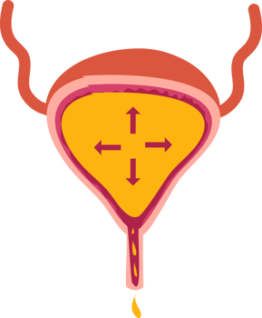 Overflow urinary incontinence illustration png
