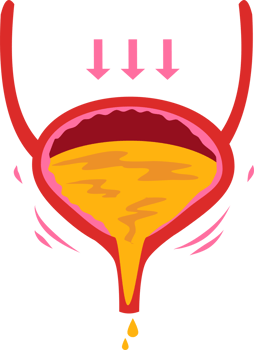 Stress urinary incontinence illustration png