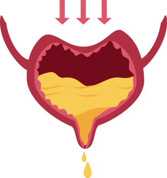 Stress urinary incontinence png