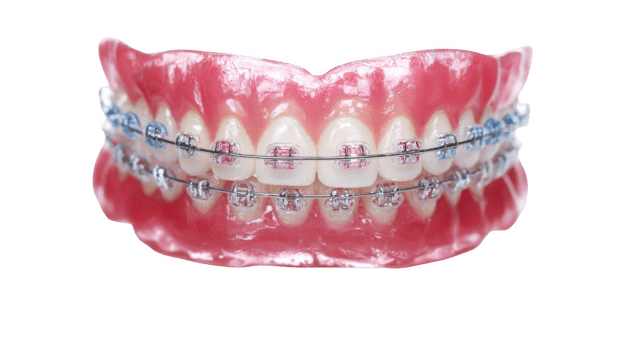 Teeth showing braces with transparent background png