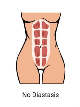 No Diastasis in a woman before and after pregnancy. The anatomy of a Woman. Woman muscular corset, body part. illustration vector
