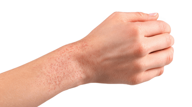 Woman showing red rash on wrist on transparent background png