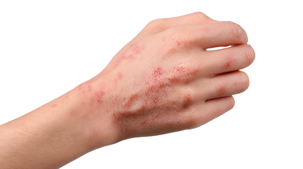 Hand showing signs of dermatitis on transparent background png