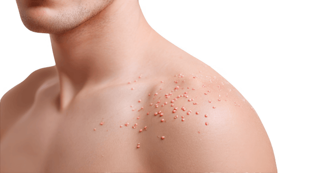 Man showing chickenpox symptoms on shoulder with transparent background png