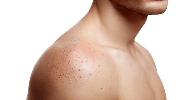 Man showing chickenpox symptoms on shoulder on transparent background png