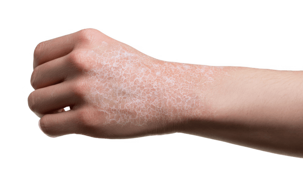 Hand showing severe eczema rash on transparent background png
